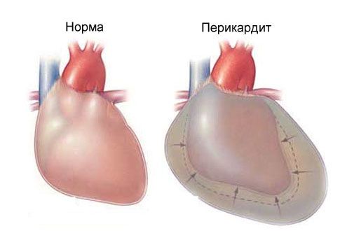 Οξεία περικαρδίτιδα και πόνους στο στήθος στα αριστερά
