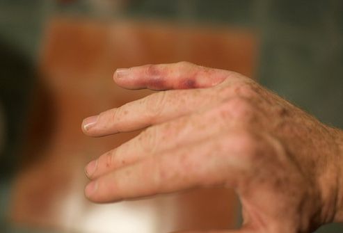 Πόνος στις αρθρώσεις των χεριών