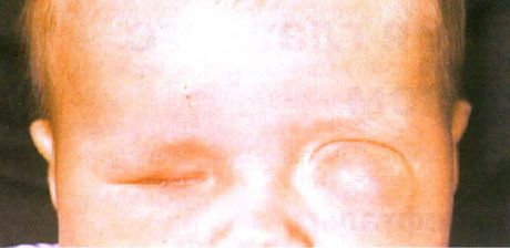 Μικροφθαλμός με ταυτόχρονη δημιουργία κύστης (αριστερό μάτι).  Ανόφθαλμος (δεξί μάτι).