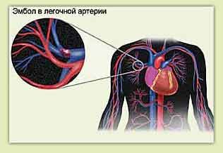 Πνευμονική εμβολή και θωρακικοί πόνοι στα αριστερά