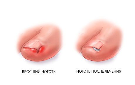 Εμπλουτισμένο toenail
