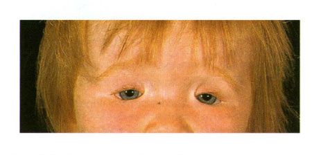 Κολωμωμα δυο πλευρών των βλεφάρων σε ένα παιδί με σύνδρομο Golden.  Κλείσιμο της σχισμής των ματιών στα αριστερά